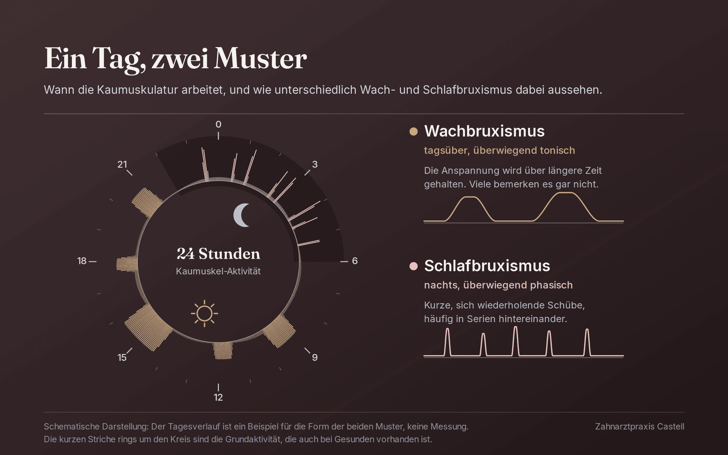 Ringdiagramm über 24 Stunden zur Aktivität der Kaumuskulatur: Tagsüber erscheint sie als längere zusammenhängende Blöcke, nachts als einzelne kurze Spitzen. Daneben sind beide Muster als Kurvenvergleich gegenübergestellt, Wachbruxismus tonisch, Schlafbruxismus phasisch.