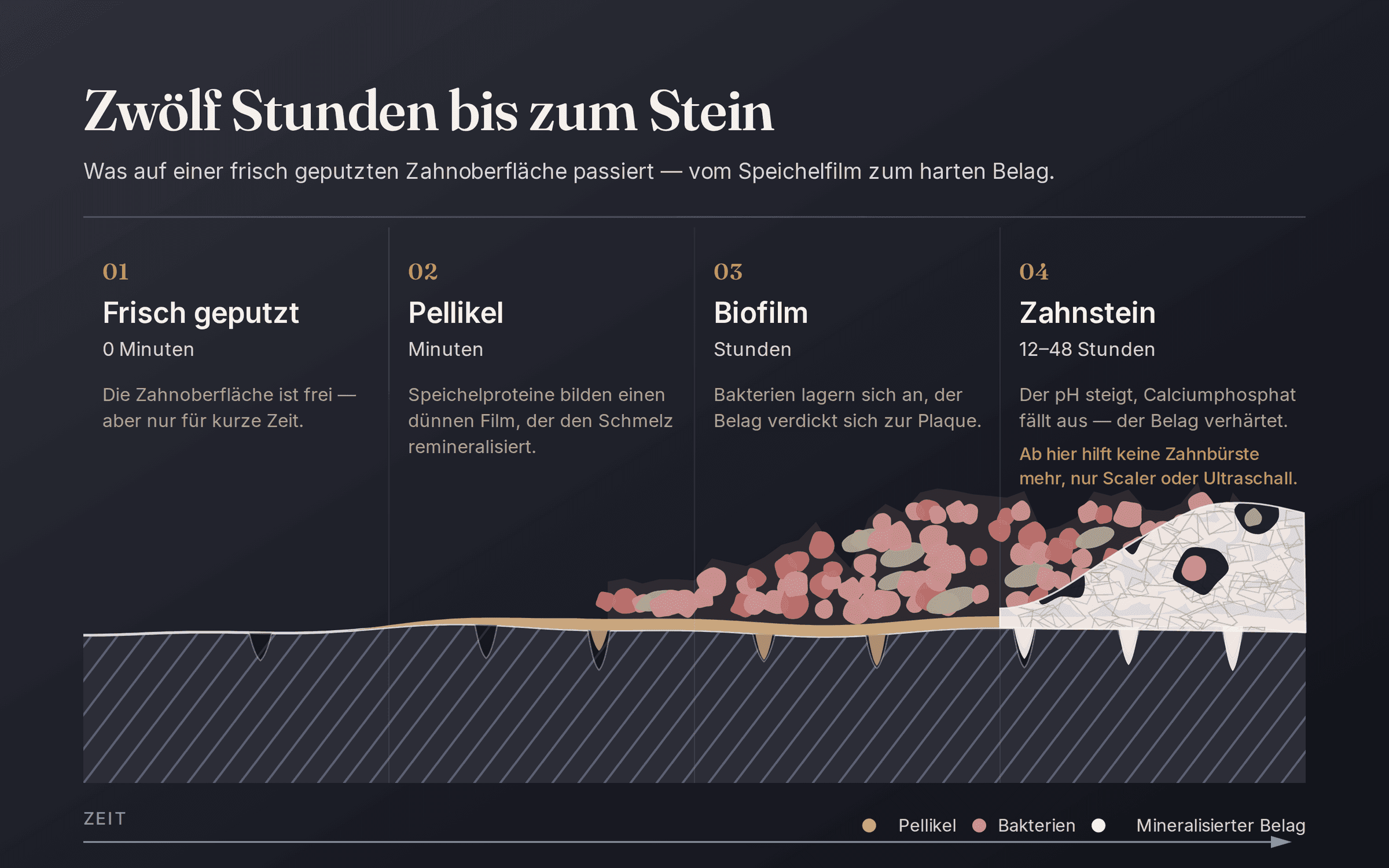 Beitragsbild: Zahnstein: Wie er entsteht und warum er sich nicht wegputzen lässt